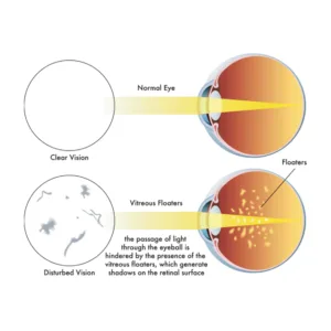 Floaters and Flashes