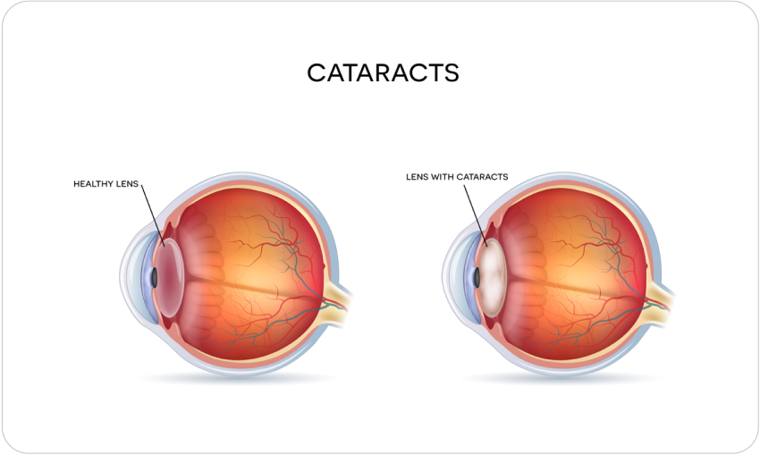 Cataracts -Nexus Eye Care