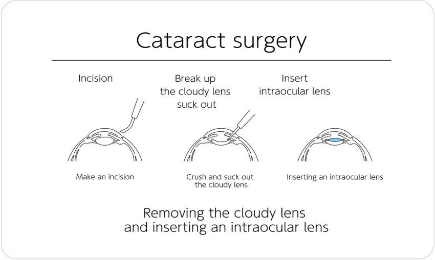 Cataract Surgery - Nexus Eye Care