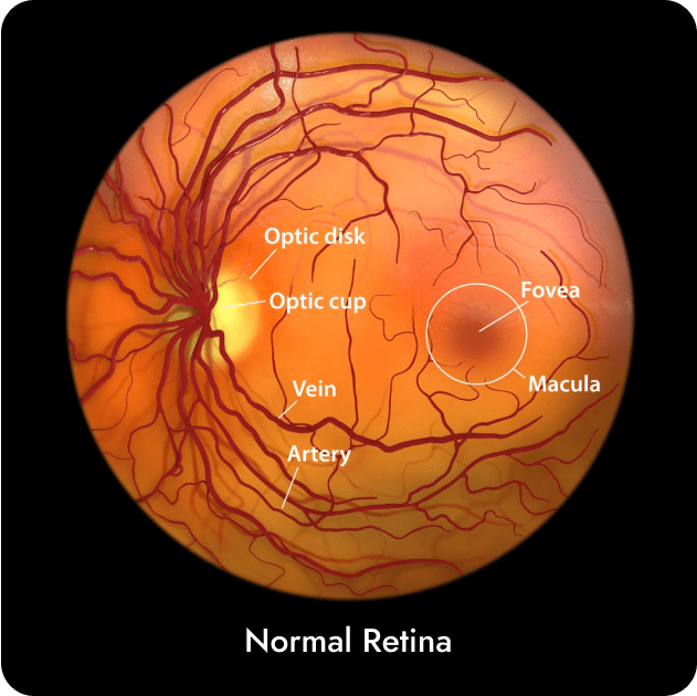 Retinal Disease - Macular Degeneration