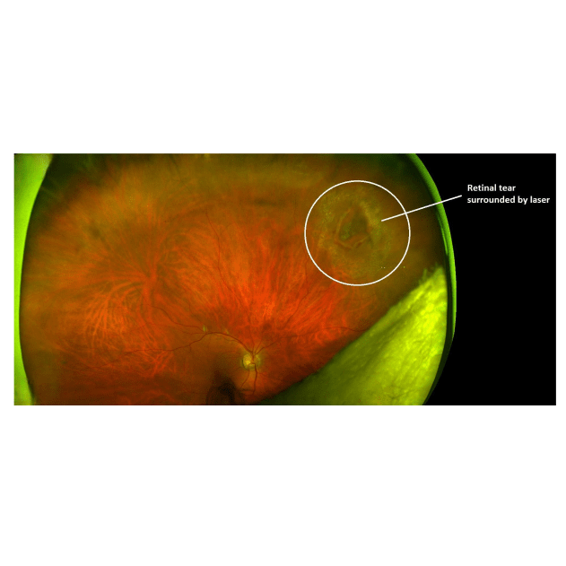 Retinal Laser Treatment