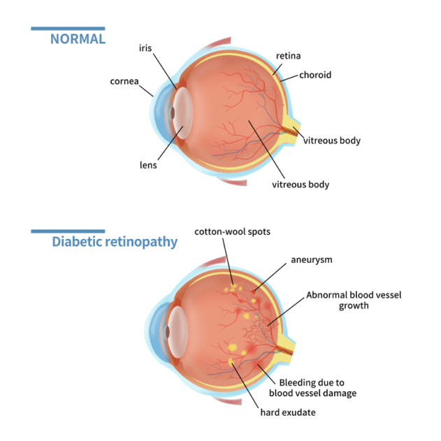 Floaters and Flashes - Nexus Eye Care