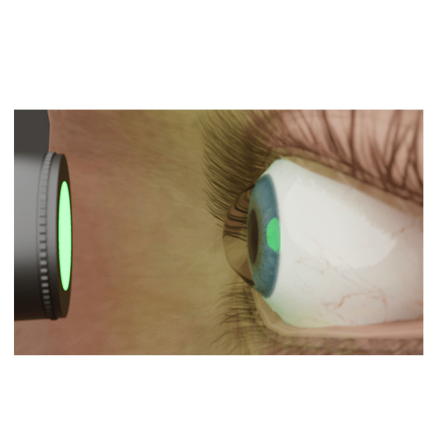 Keratoconus & CXL - Nexus Eye Care