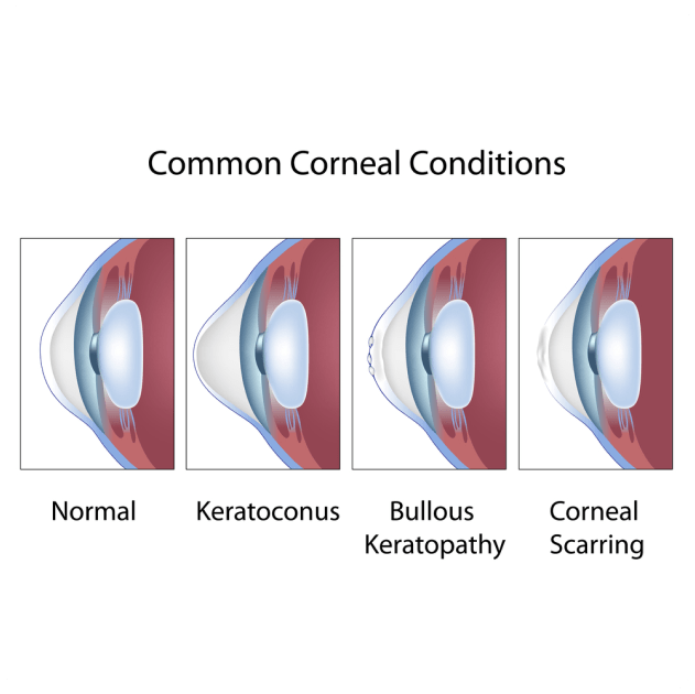corneal graft surgery