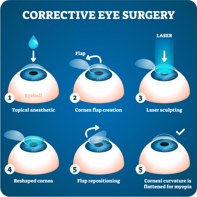 Laser eye surgery Treatment