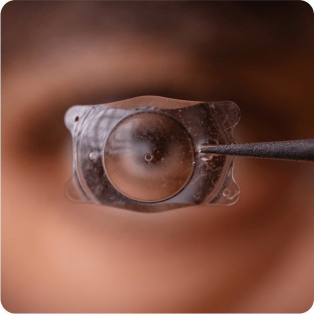 ICL Implantation - Nexus Eye Care