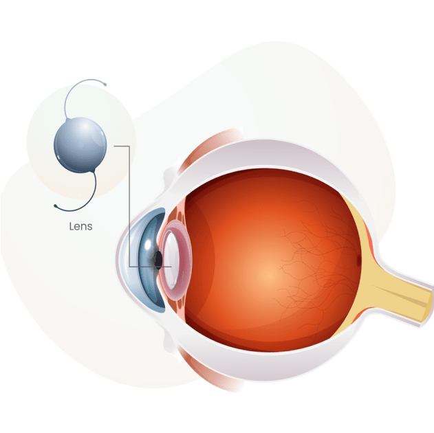 Glaucoma Treatment - Nexus Eye Care