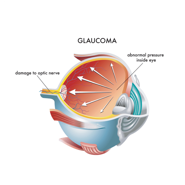 Glaucoma - Nexus Eye Care