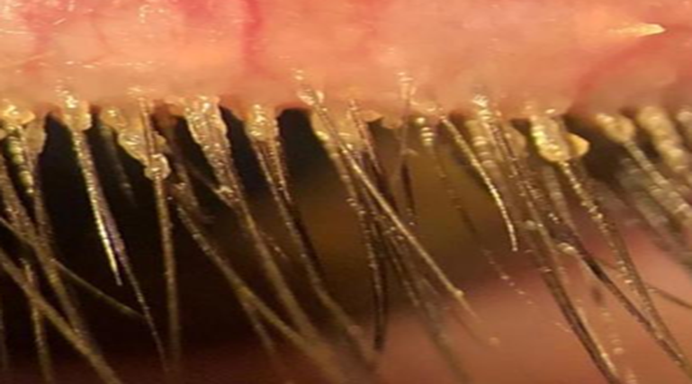 What Is Demodex?